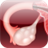 Polycystic Ovary Syndrome icon